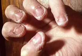 رفتارهای تکراری متمرکز بر بدن رفتارهای تکراری متمرکز بر بدن